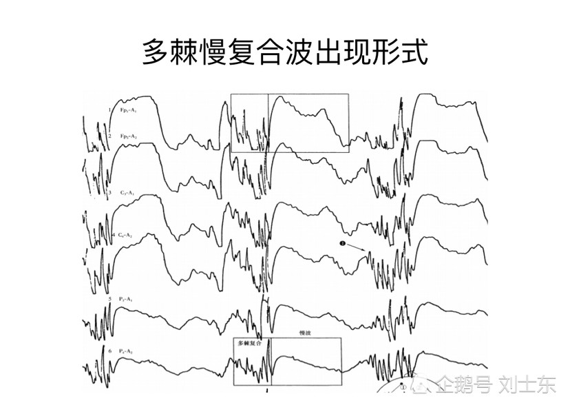 儿童脑电图基础与判读解析