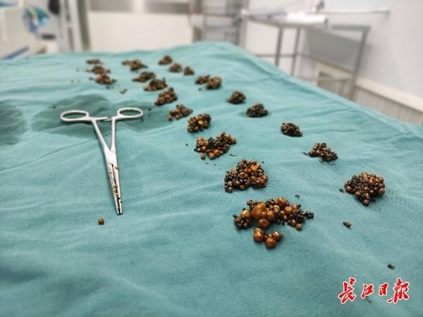 普通外科曹庭加主任为一名患者实施了含大量胆囊结石的微创胆囊切除术