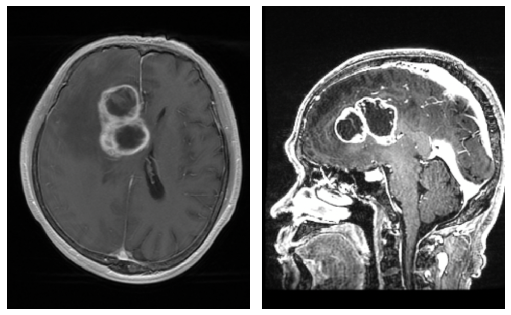 恶性的高级别胶质瘤生长在脑部可能引起健忘记忆力下降