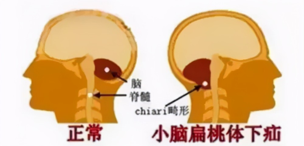 孩子出现小脑扁桃体下疝畸形,要不要手术?