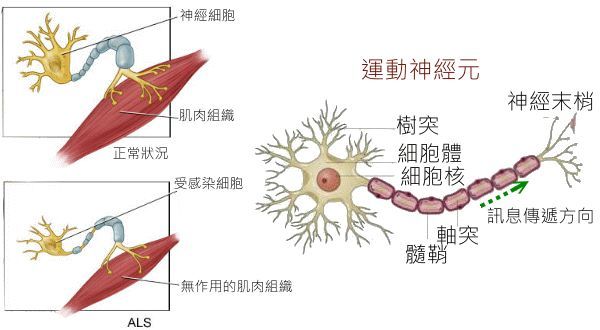 为什么运动神经元病会出现肌肉萎缩