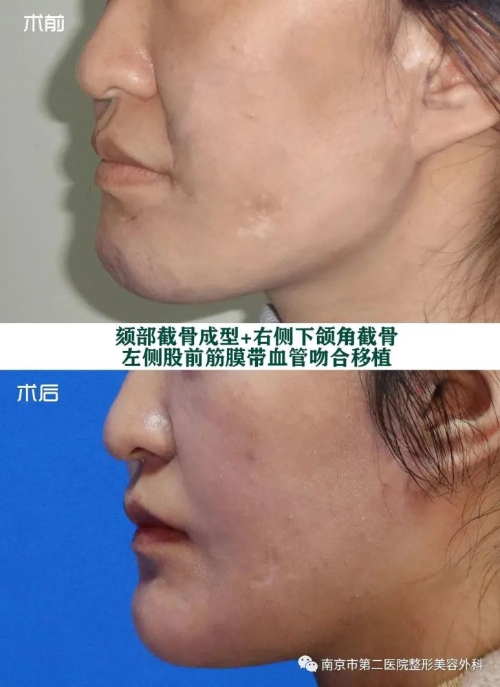 面部畸形困扰多年,整形妙手恢复容颜