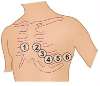 颠覆传统,巧看心电图:v1,v2,v3导联不仅仅是胸前导联
