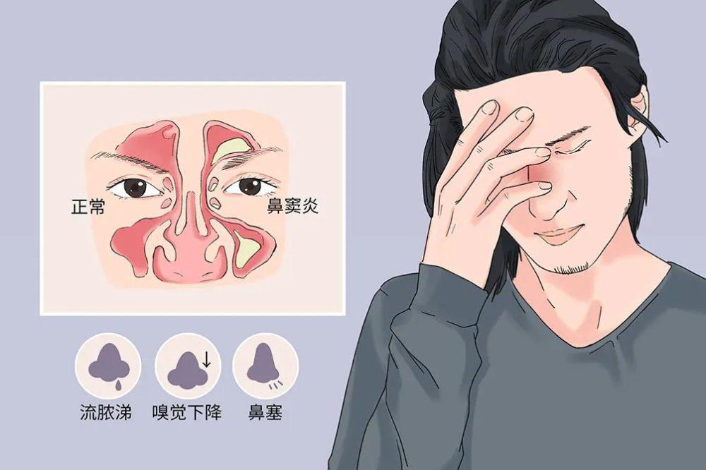 什么是鼻窦炎