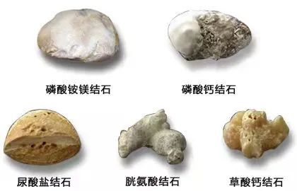 如何"看"出结石的成分: 1,看颜色 褐色或者白色的,可能是草酸钙结石