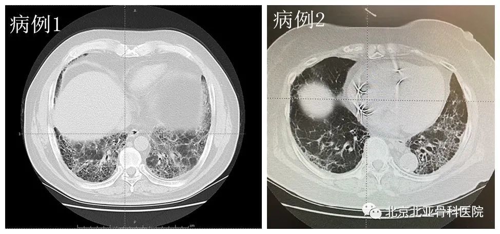 所以对于此病的治疗主要分为以下几种: 抗纤维化药物治疗 目前主要是