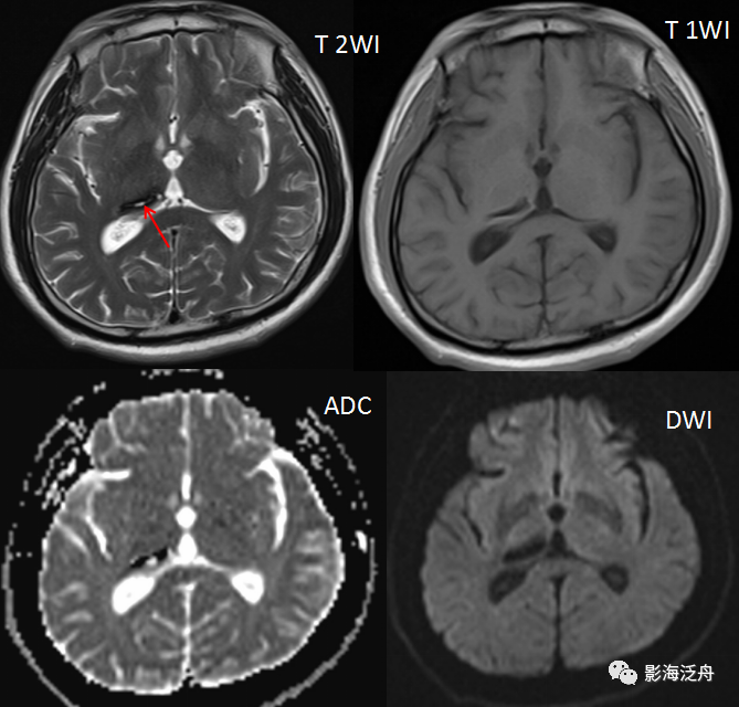 而病灶中心为完全液化区,呈水样信号(红箭.来源:影海泛舟【版权声明