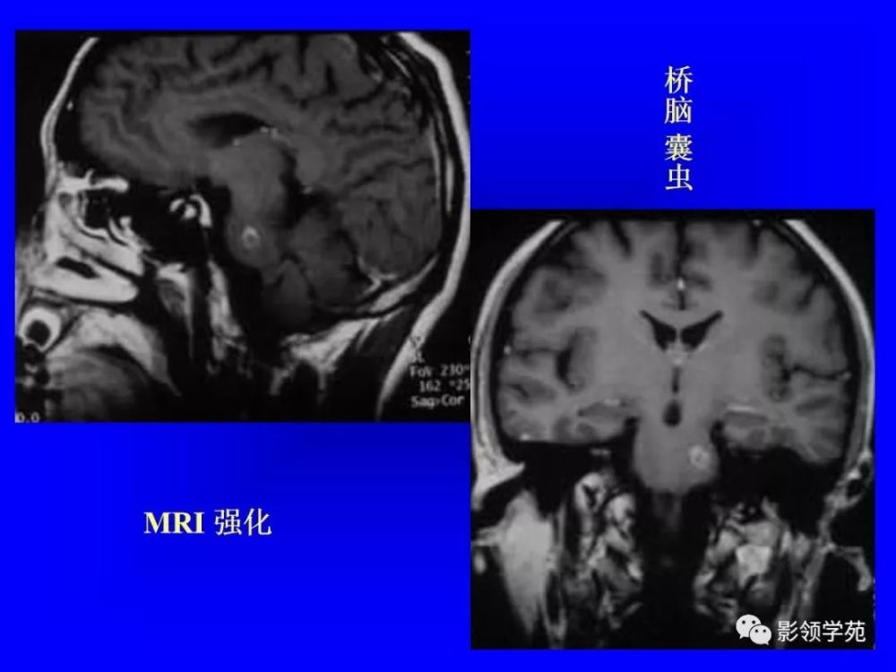 颅内多发结节性病变的鉴别诊断
