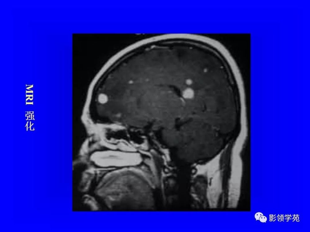 颅内多发结节性病变的鉴别诊断