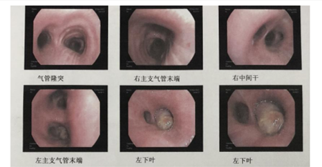 围观肺叶袖状切除术让肺癌患者过上肺凡人生