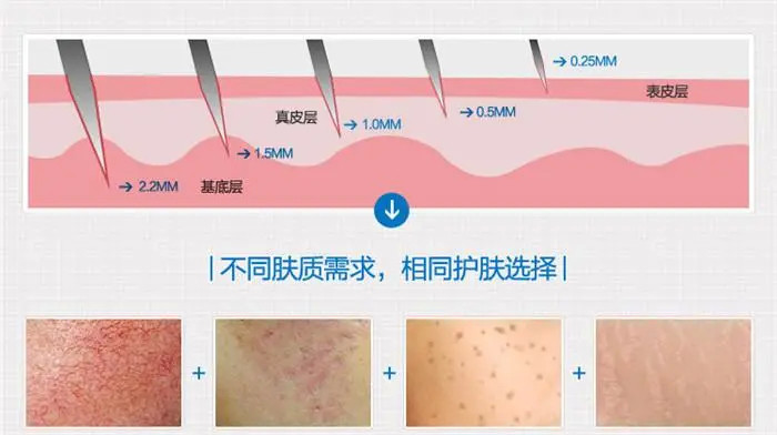 收缩毛孔的医美项目