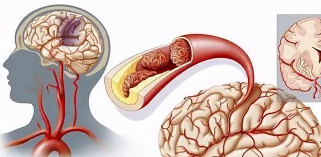 【脑梗】睡觉有4异常,说明脑血管 "堵塞" 严重!