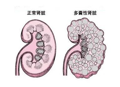 【案例分享】肾囊肿破裂致感染,使血肌酐一周涨了300多