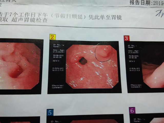 腹胀,恶心,胃灼热等现象,则应及时进行胃镜检查,检查胃和十二指肠是否