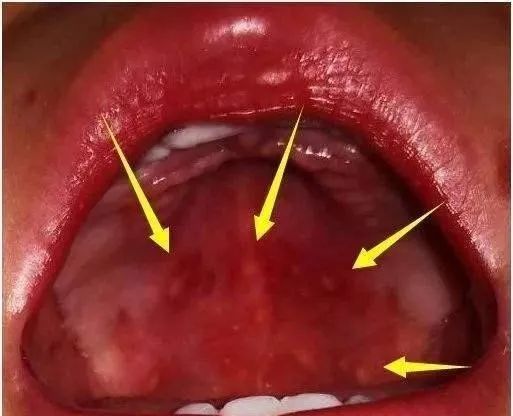 小儿疱疹性咽峡炎进入高发期区别于手足口病该如何治疗