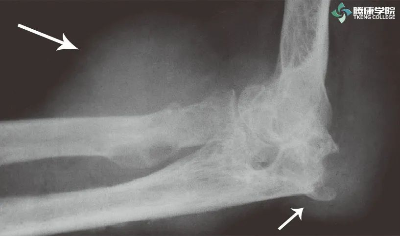 过度外翻伸展试验有助于检查者鉴别后内侧尺骨鹰嘴骨赘或者尺骨鹰嘴窝