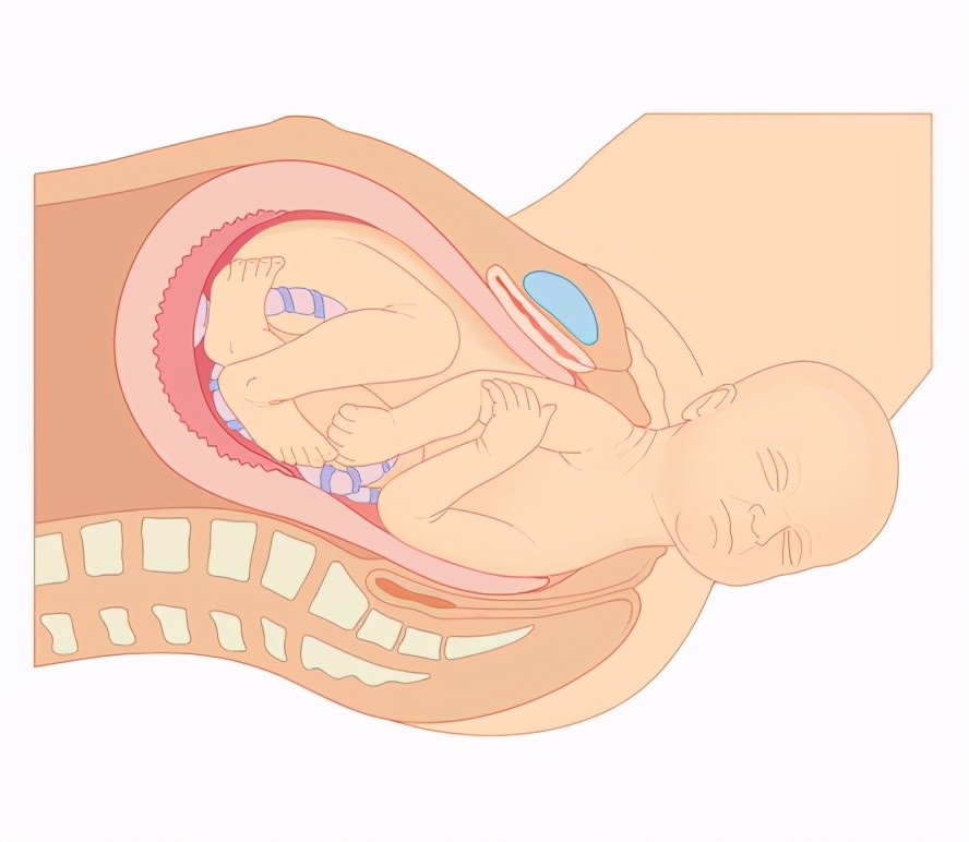 胎儿脐绕颈两周 还能顺产吗?