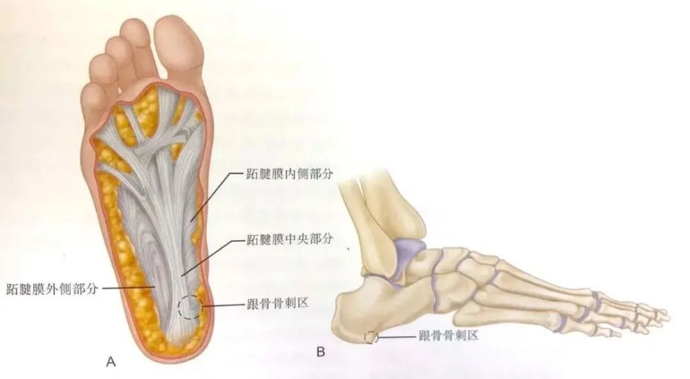 由跟骨内侧结节足底筋膜起源处的胶原变性(有时被称为"慢性炎症")引起