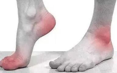 脚后跟痛多半离不开这些原因