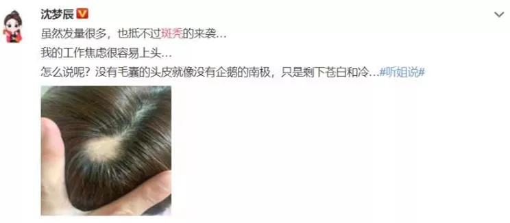 都是很大的,一般人都会掉发,特别是晚上睡觉,早上起来枕头皆是头发
