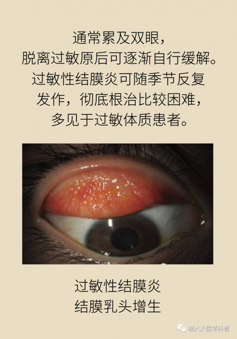 花粉满天飞眼睛痒小心是过敏性结膜炎