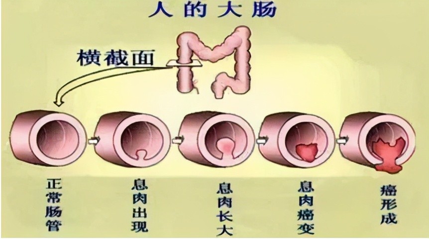 家族性结肠息肉并全结肠与直肠均会出现多发性腺瘤,一般息肉都在100