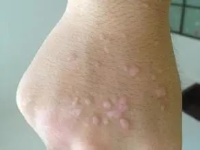 【肤康·科普】身上有这种"小瘊子"一定要注意了!