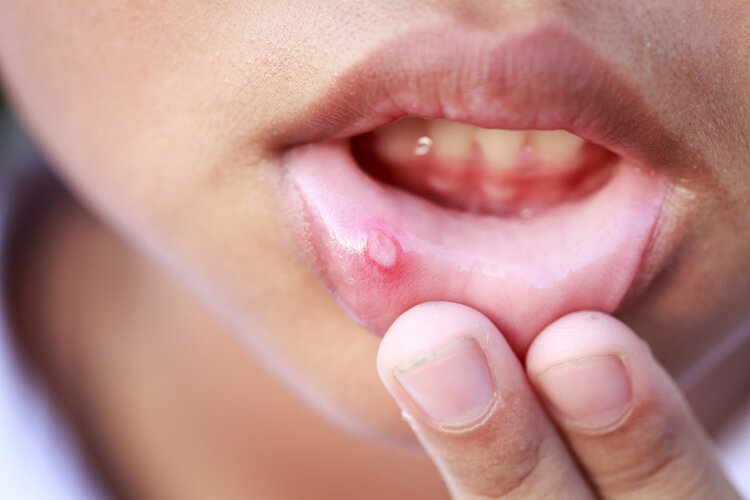 女子口腔发现白斑,检查确诊癌症!4种病出现,警惕是癌前病变