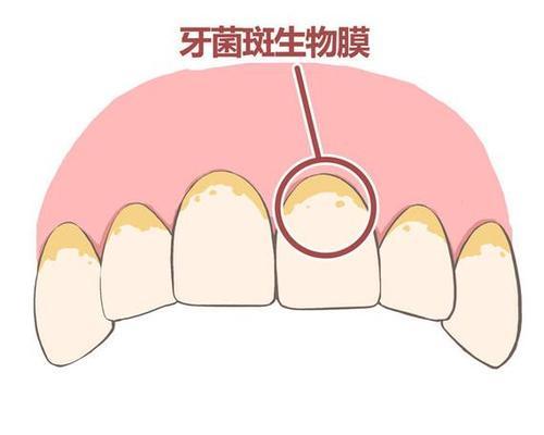 小小牙菌斑居然会有这么大伤害