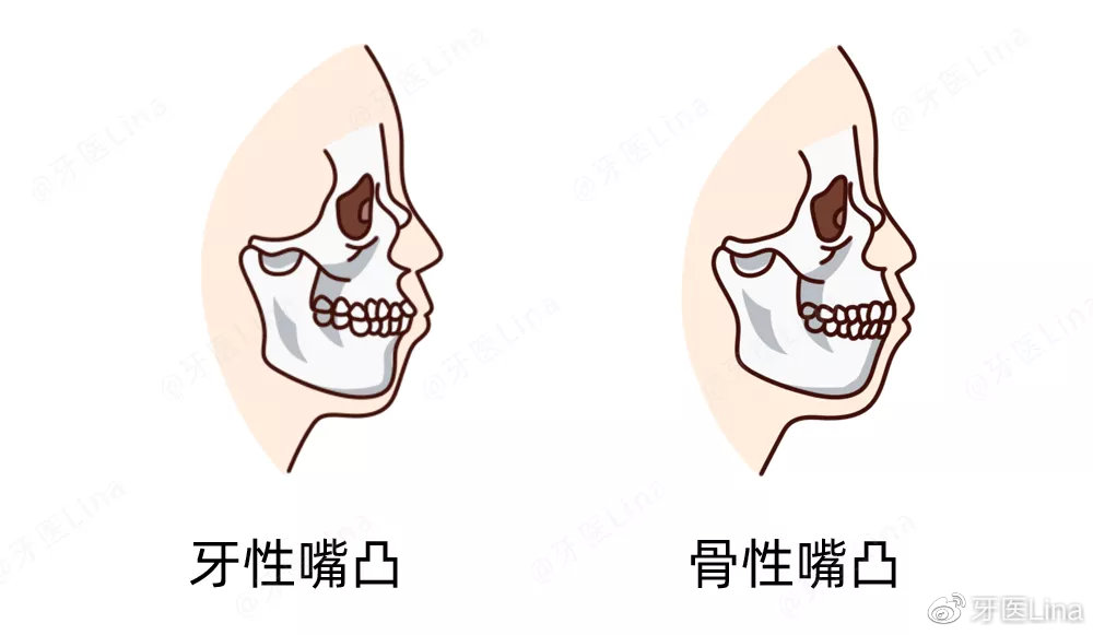 但是 骨性嘴凸是颌骨凸,也就是颌骨发育过度,这种情况只靠单纯正畸是