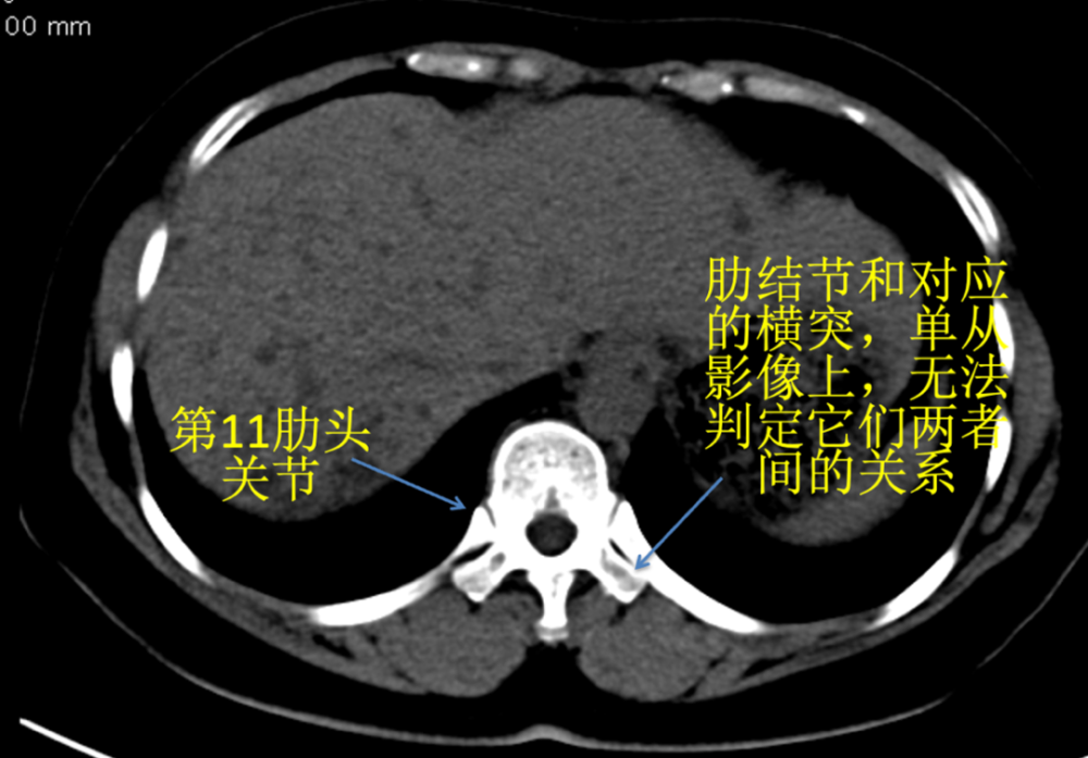 图37 11肋的肋结节和横突的关系在影像上无法辨识的