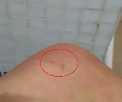 图源网络 蜈蚣咬后的伤口一般是 一对小孔 被蜈蚣咬伤后,严重时会出现