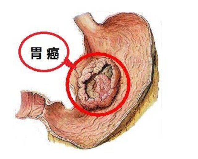 反酸胃胀一查竟是癌老人接受微创小切口技术完成胃癌大手术