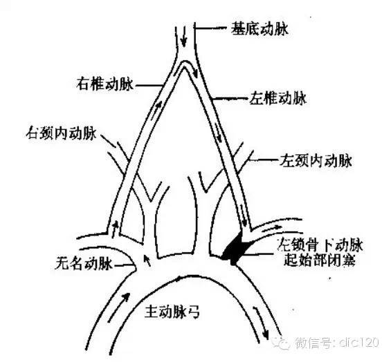 锁骨下动脉盗血综合征