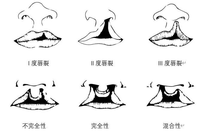 科普小课堂|唇裂治疗知多少