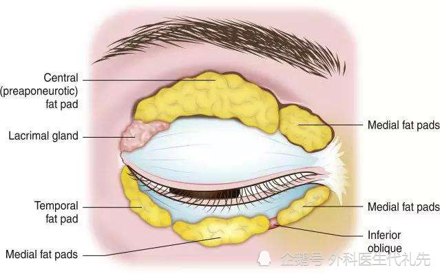 眼周眶隔脂肪分布