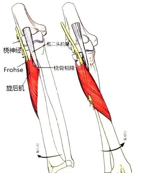 外侧肌间隔:位于肱骨外上髁上方10厘米,在该处桡神经常被交叉的腱性