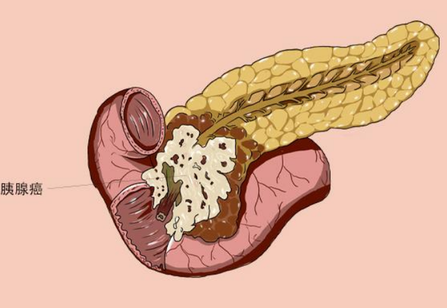 胰腺癌不是悄悄来临,出现3个症状,或要留心观察,别再忽视