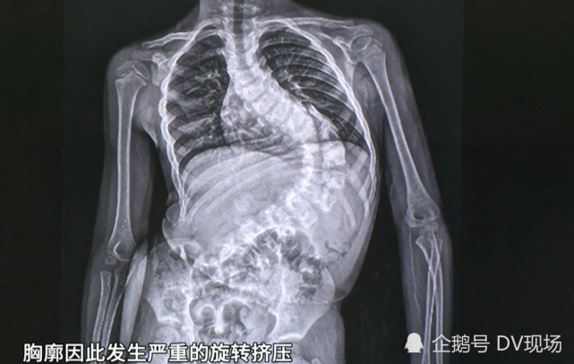 5岁男童脊柱侧弯超100度,心肺功能受影响