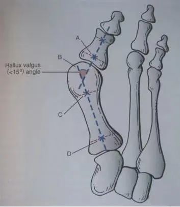 骨科精读3分钟get拇外翻的术式选择及诊治技巧看看你做的对吗