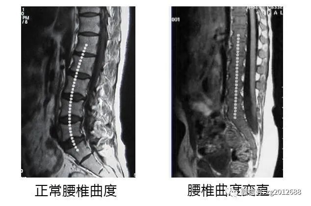 腰椎间盘突出,腰椎曲度变直?在家躺床上,运用妙方来恢复