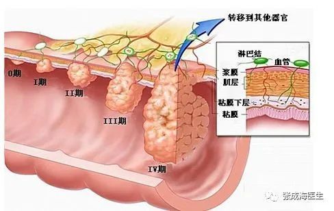 结直肠癌分期模式图