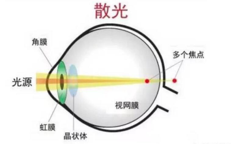 近视通常伴随着散光,什么是散光,如何预防与纠正散光?