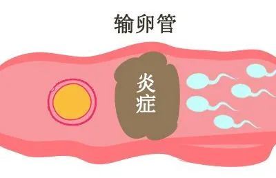 南昌华儿山生殖医院:输卵管通而不畅,还能自己怀上吗?