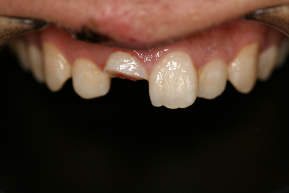 牙齿缺损修补后,患者直呼:"天啊!和真牙一模一样!