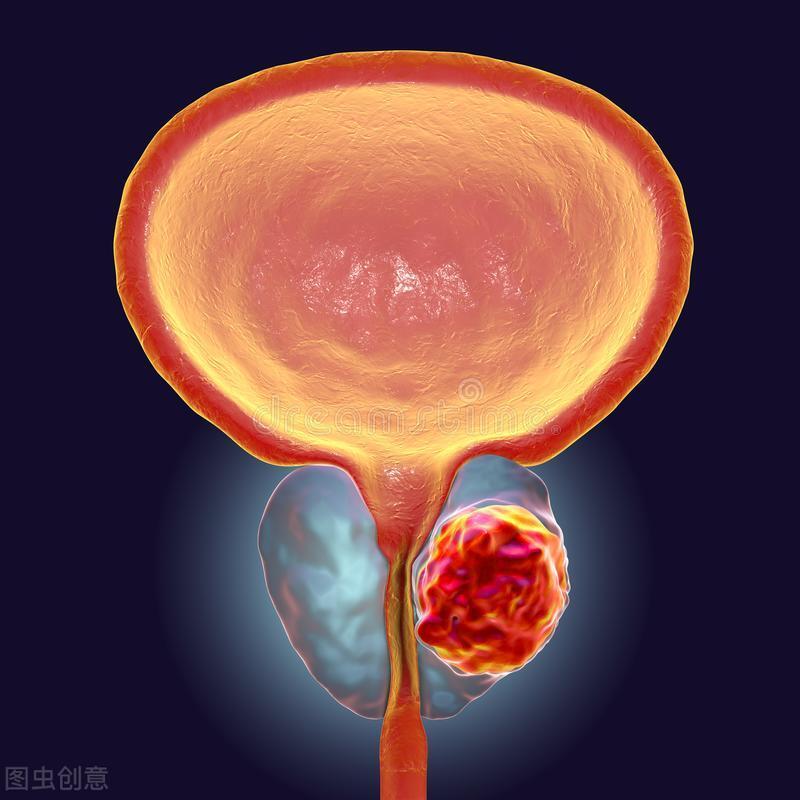 体检发现前列腺钙化灶严重吗应该怎么办医生给你六点建议