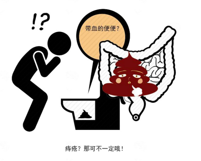 大便出血是直肠癌?提醒:若伴有4个异常,尽快去医院
