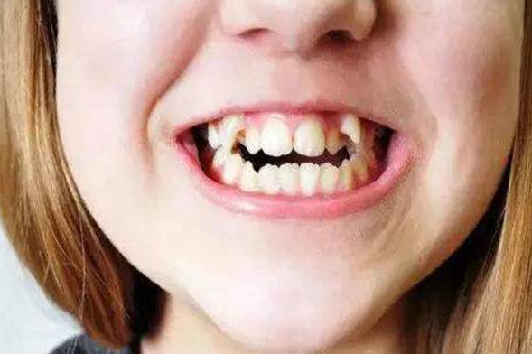 孩子几岁的时候牙齿矫正比较合适