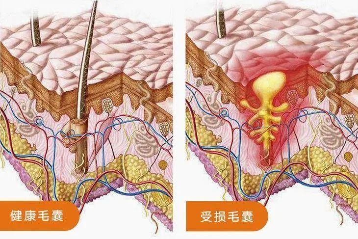 毛囊堵塞也会引起脱发吗?广州粤波医院