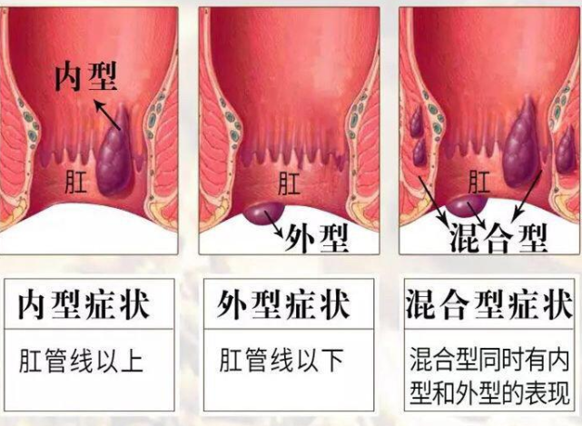 为啥女性更容易得痔疮?如何预防?